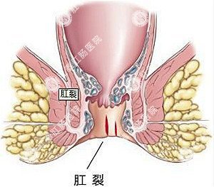 患了痔疮等自愈？小心并发症来袭