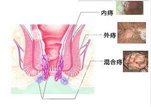 患了痔疮等自愈？小心并发症来袭