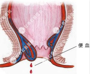 患了痔疮等自愈？小心并发症来袭