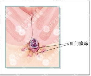 患了痔疮等自愈？小心并发症来袭